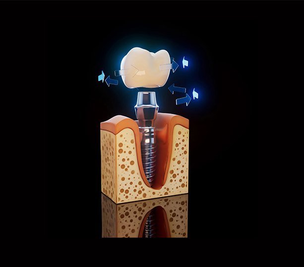 Dental Implants